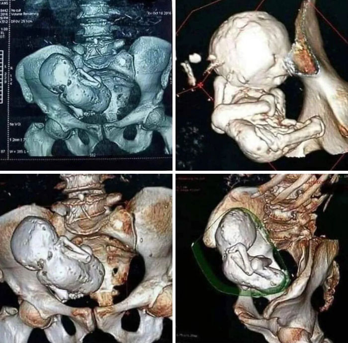 Imágenes 3D médicas mostrando detalles de un feto dentro de la pelvis, ejemplo de cosas interesantes para compartir.