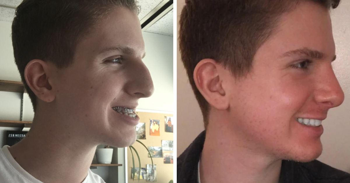 Joven sonriente mostrando el cambio tras cirugu00eda plu00e1stica con antes y despuu00e9s de rostro y sonrisa derecha.