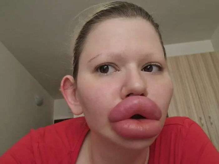 Mujer con los labios más grandes del mundo tras cirugías extremas valoradas en 26 mil dólares, vistiendo camiseta roja.