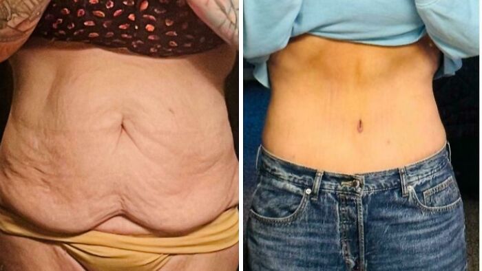 Antes y después de abdomen tras cirugía plástica, mostrando cambio notable en 30 personas que se ven irreconocibles.