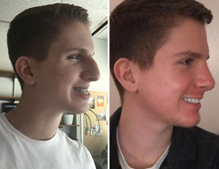 Joven antes y después de cirugía plástica, mostrando un cambio irreconocible en su rostro y sonrisa.