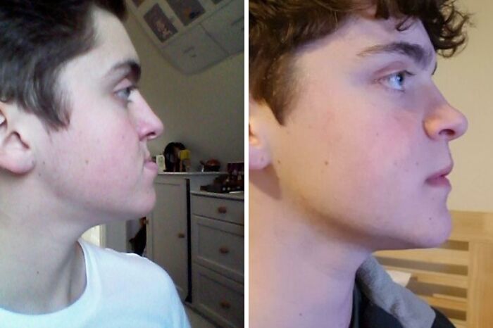 Joven mostrando cambio visible en su perfil facial tras cirugía plástica, ejemplo de personas irreconocibles.