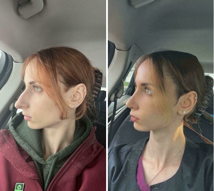 Mujer joven con cambio visible en su rostro tras cirugía plástica, mostrando transformación irreconocible en dos fotos.