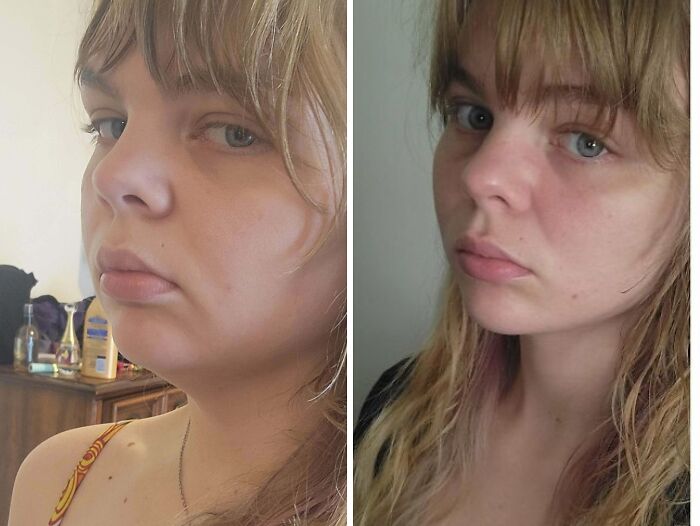 Mujer joven mostrando cambios visibles en su rostro antes y después de cirugía plástica irreconocible.