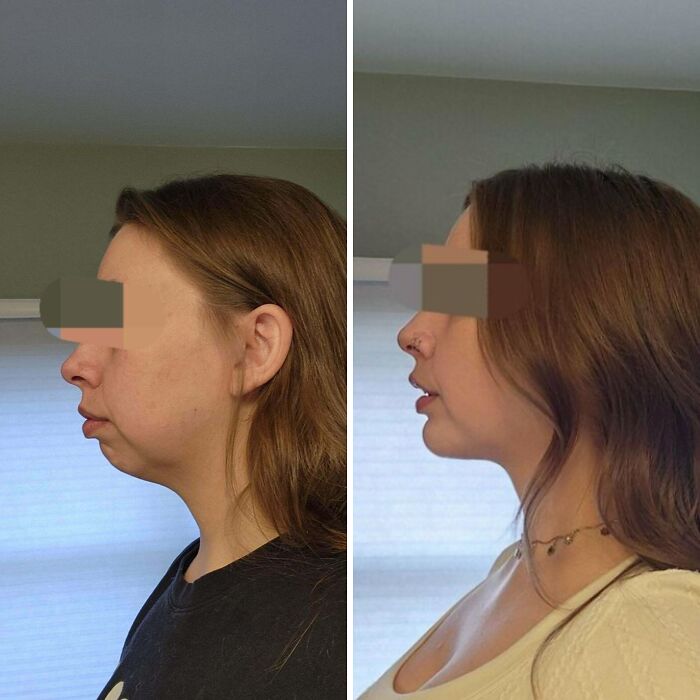 Mujer con cambio notable en perfil facial antes y después de cirugía plástica mostrando resultados irreconocibles.