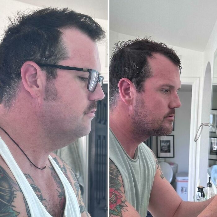 Hombre con cambio notable en su apariencia facial antes y después de cirugía plástica, mostrando resultados irreconocibles.