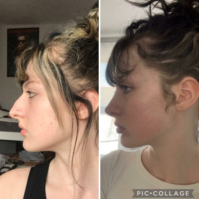 Perfil de mujer joven antes y después de cirugía plástica, mostrando cambios visibles en rostro y nariz, cirugía plástica irreconocible.
