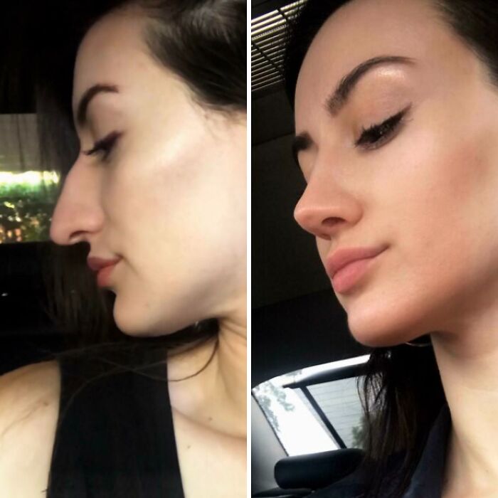 Mujer mostrando cambio facial notable antes y después de cirugía plástica con resultados que la hacen irreconocible.
