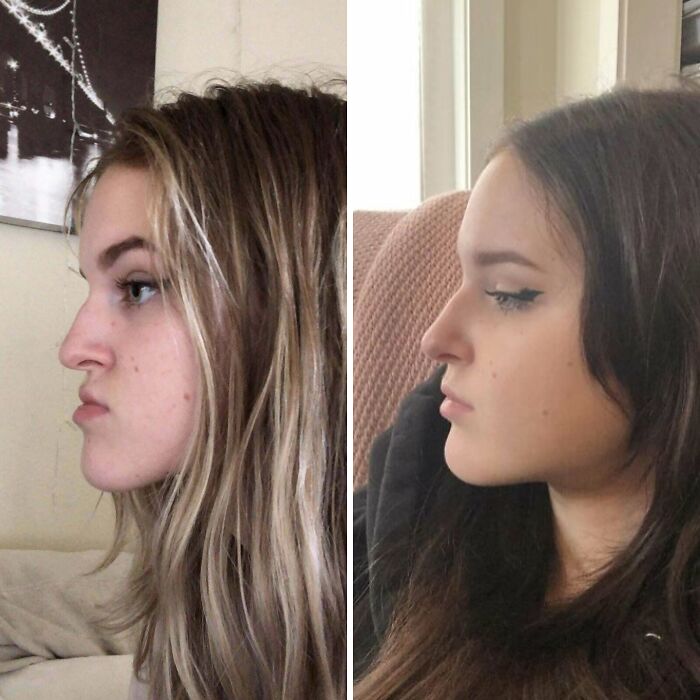 Mujer antes y después de cirugía plástica, cambio notable en perfil facial y apariencia irreconocible tras procedimiento.