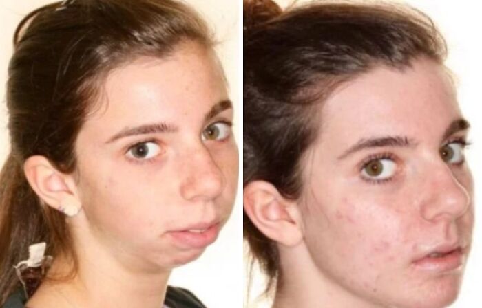 Mujer joven antes y después de cirugía plástica, mostrando cambios irreconocibles en su rostro.