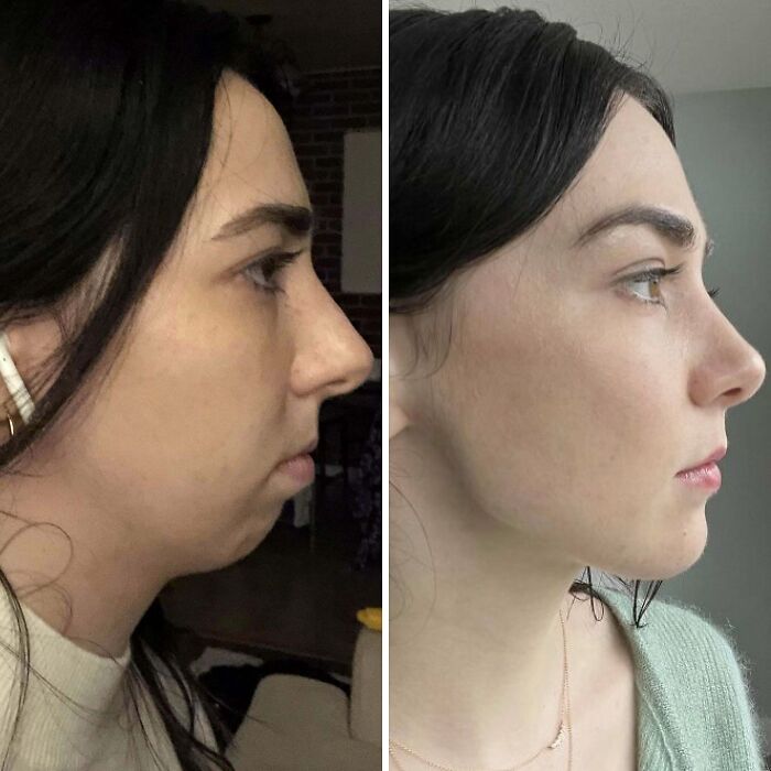 Antes y después de una mujer que se ve irreconocible tras su cirugía plástica en el rostro y la nariz.