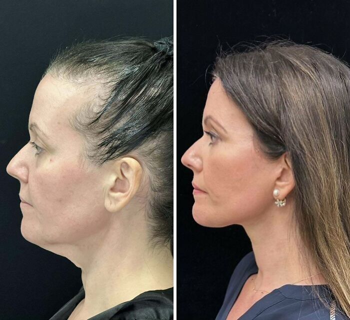Antes y después de cirugía plástica mostrando cambio notable en el perfil facial en personas que se ven irreconocibles.