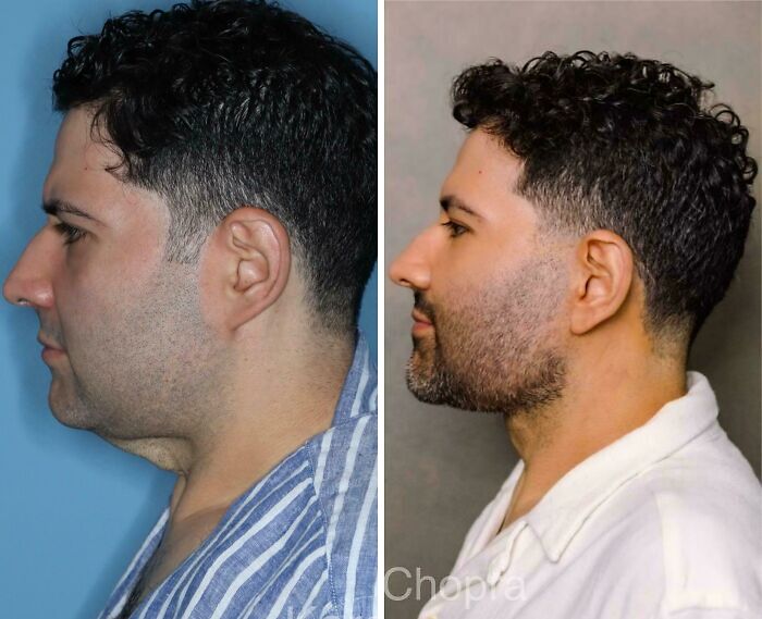Hombre antes y después de cirugía plástica mostrando cambios irreconocibles en su perfil facial y barba.