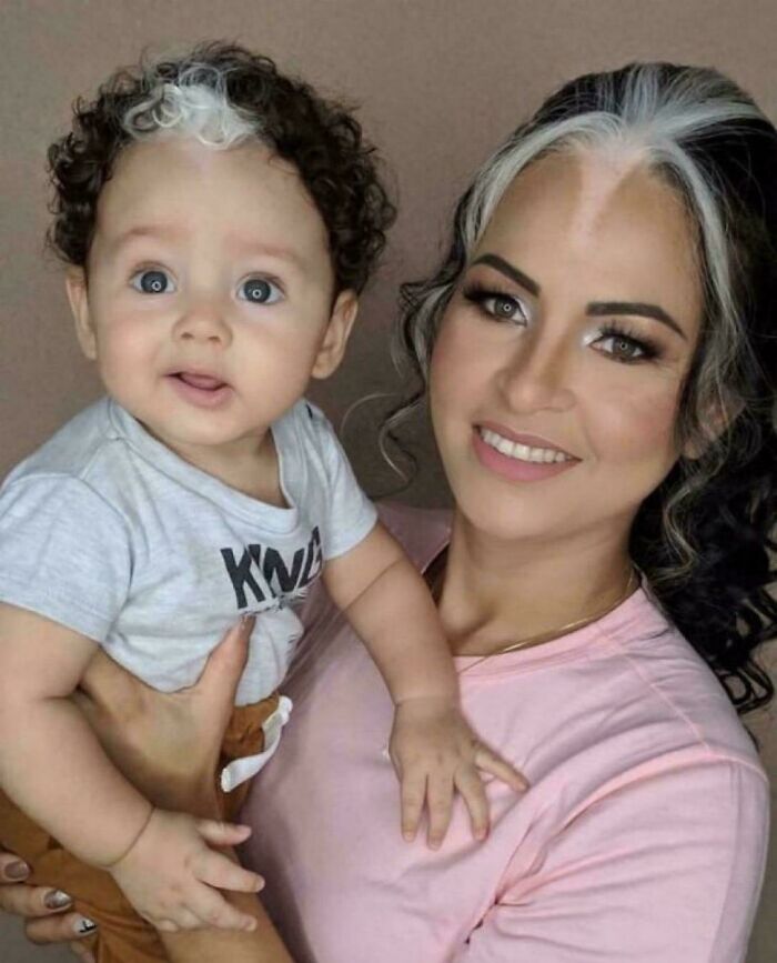 Madre e hijo con mechones blancos en el cabello, mostrando un dato interesante respaldado con imágenes del mundo.