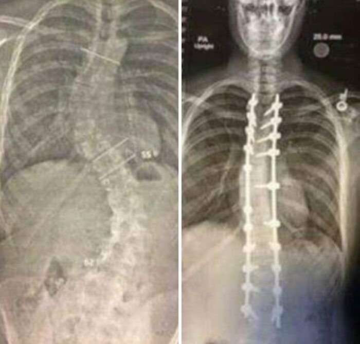 Radiografías comparativas antes y después de cirugía de columna, mostrando diversidad inesperada de la vida en anatomía humana.