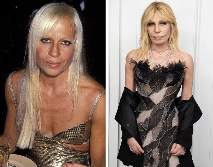 Fotos de antes y después de celebridades mostrando cambios exagerados por cirugía plástica en el rostro y cuerpo.