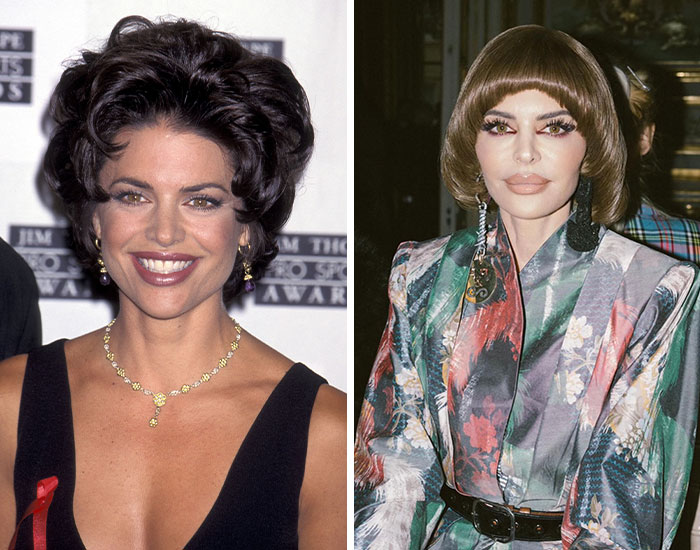 Fotos de antes y después de celebridades que se excedieron con la cirugía plástica mostrando cambios faciales evidentes.
