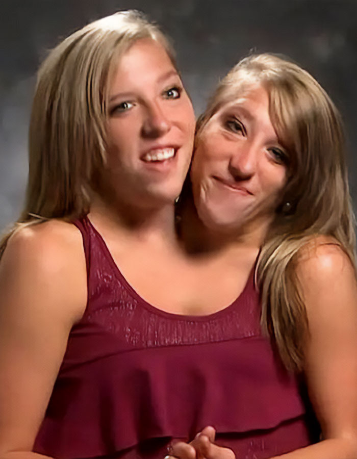 Hermanas siamesas Abby y Brittany Hensel sonrientes, causando revuelo tras ser vistas con un bebé recién nacido.