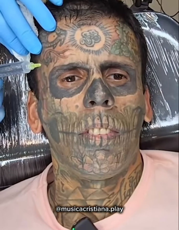 Hombre brasileño con 95% del cuerpo tatuado recibiendo tratamiento de eliminación de tatuajes con láser en rostro y cuello