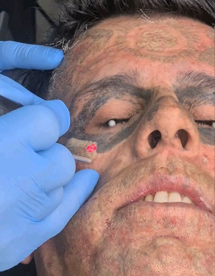 Hombre con 95% del cuerpo tatuado recibiendo eliminación de tatuajes con láser en el rostro, cambio impactante visible