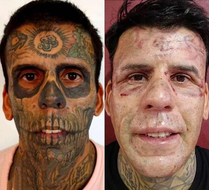 Hombre con 95% del cuerpo tatuado antes y después de la impactante eliminación de tatuajes con láser en rostro y cuello.