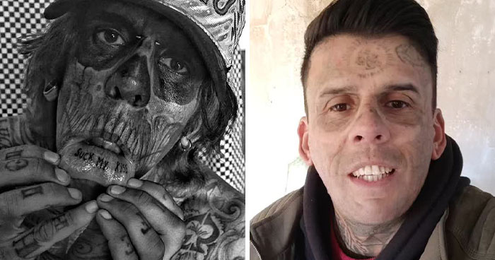 Hombre brasileño con 95% del cuerpo tatuado antes y después de la eliminación láser mostrando piel casi limpia y nuevo aspecto.