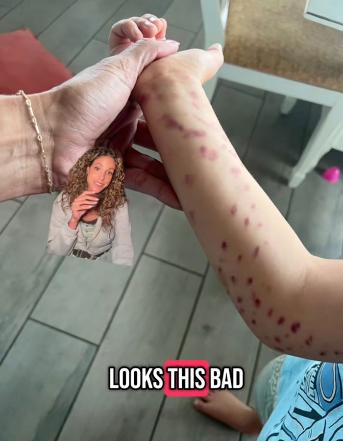 Brazo magullado de niño de 6 años con marcas rojas tras ataque de pulpo en acuario, mostrando heridas visibles.