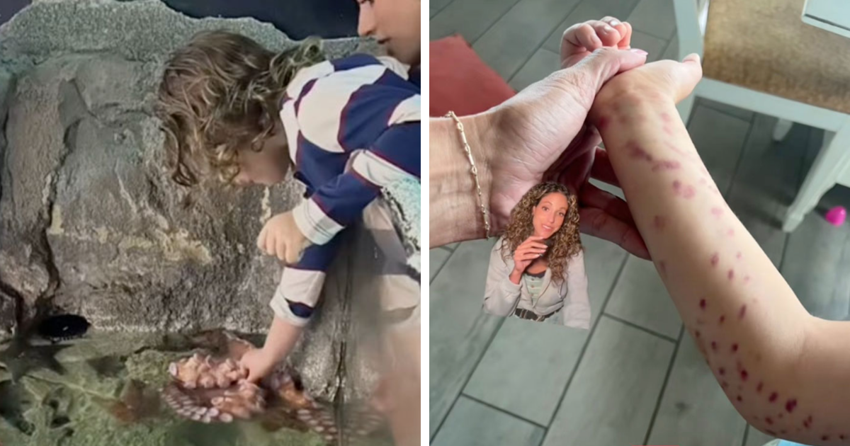 Niu00f1o tocando pulpo en acuario y brazo con marcas por ataque del pulpo que se volviu00f3 blanco al verlo despuu00e9s.