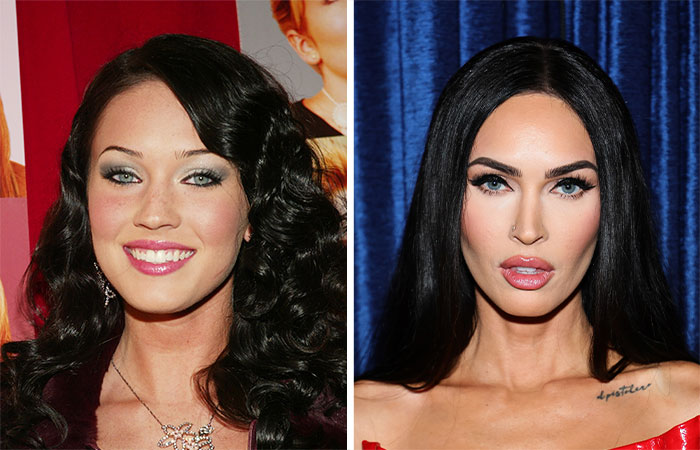 Comparación de celebridades antes y después de la eliminación de grasa bucal que cambió su belleza facial.