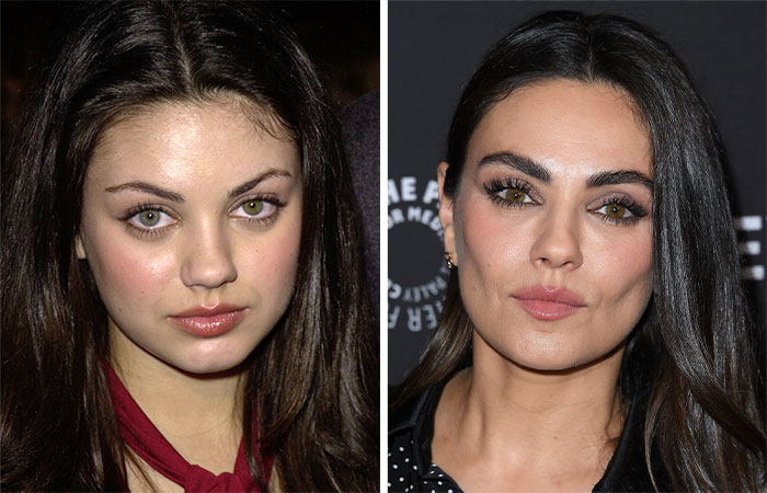Comparación de celebridad antes y después de la eliminación de grasa bucal, cambio facial destacado y opiniones de fans sobre su belleza.