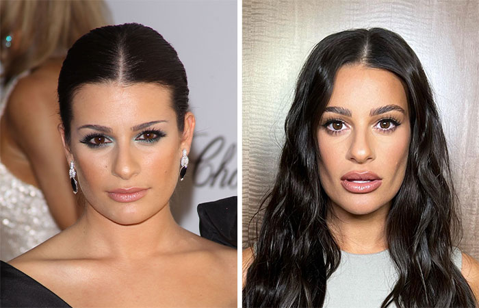Comparación de celebridades antes y después de la extracción de grasa bucal, mostrando cambios en la belleza facial.