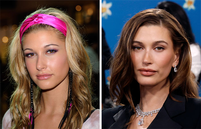 Comparación de celebridades antes y después de la eliminación de grasa bucal que afectó su belleza facial.