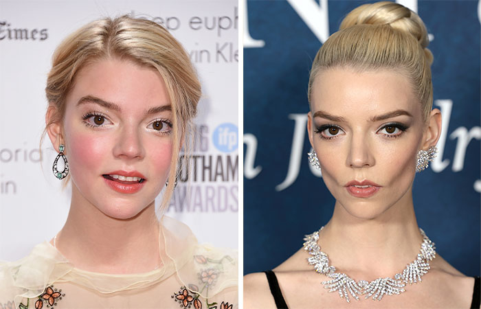 Actriz famosa antes y después de la eliminación de grasa bucal, cambio controversial en la belleza facial de celebridades.