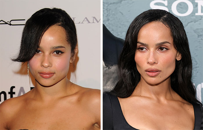 Actriz famosa en dos fotos comparando su rostro antes y después de la eliminación de grasa bucal que cambió su belleza.