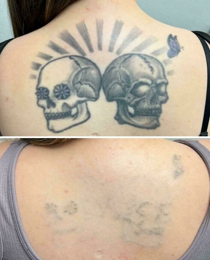 Tatuaje de calaveras en la espalda antes y después de la eliminación de tatuajes con cambio visible notable.