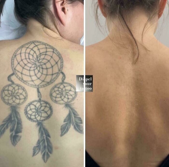 Antes y después de la eliminación de tatuajes en la espalda, mostrando el cambio significativo tras el tratamiento.