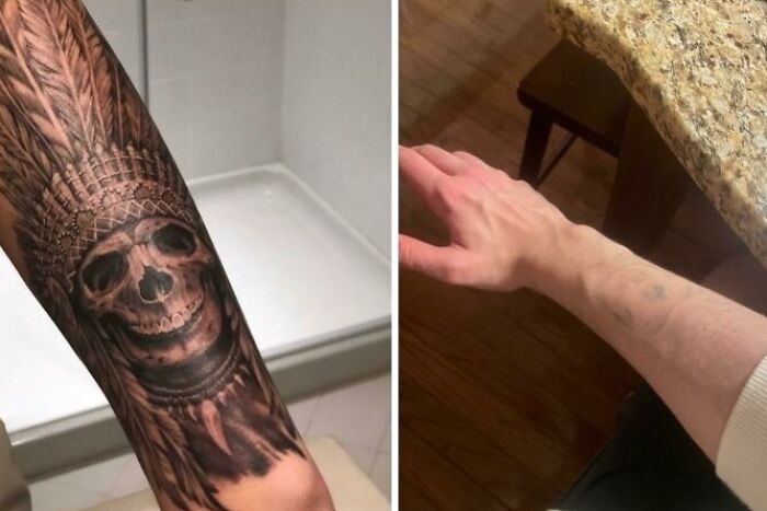 Brazo con tatuaje de calavera antes y después de la eliminación del tatuaje mostrando cambio significativo en la piel.