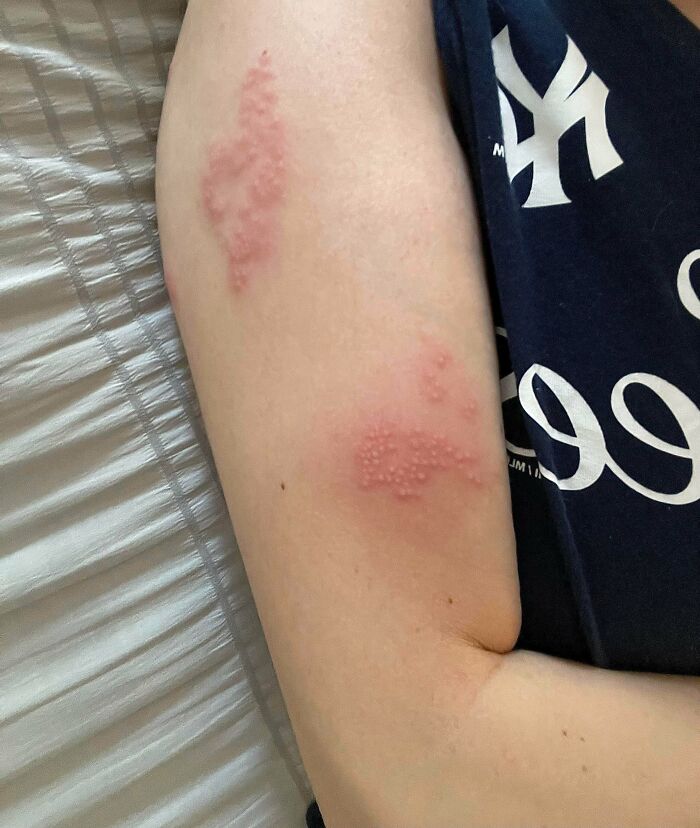 Mano con erupciones rojas inesperadas durante vacaciones, ejemplo de fotos de vacaciones que no salieron como se esperaba.