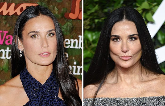 Foto comparativa de celebridad antes y después de la eliminación de grasa bucal, mostrando cambios en su belleza facial.