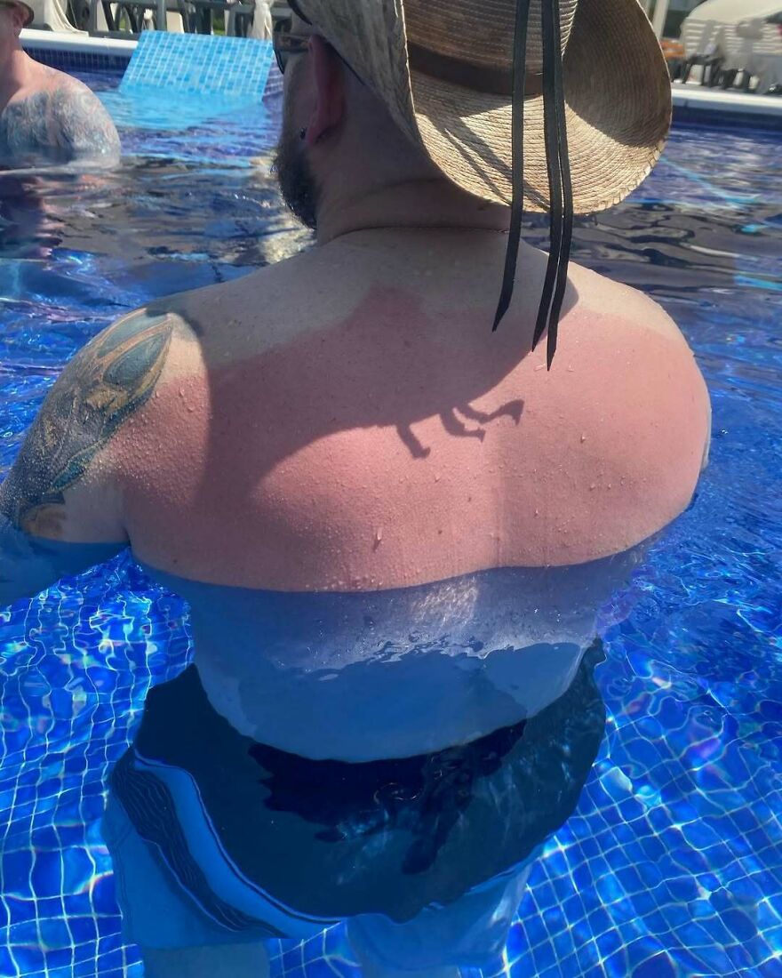 Hombre con quemadura de sol en la espalda en piscina, olvidó que su esposa le aplicara protector solar en la espalda.