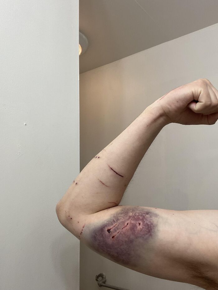 Brazo con moretón grande y cortes visibles que muestran consecuencias peligrosas sin darse cuenta del riesgo.
