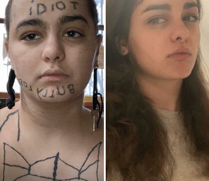 Antes y después de la eliminación de tatuajes en rostro y pecho mostrando cambio significativo en la piel y apariencia.