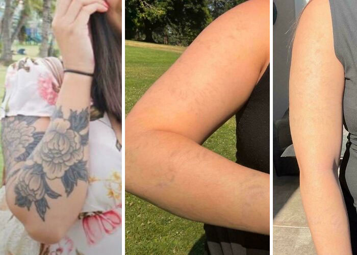 Brazo femenino con tatuaje antes y después del proceso de eliminación de tatuajes mostrando resultados efectivos.