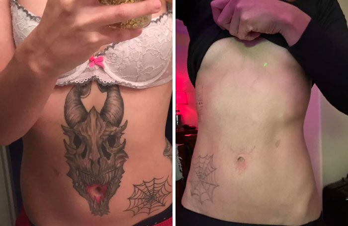 Comparación antes y después de la eliminación de tatuajes en el abdomen mostrando resultados visibles y mejora de la piel.