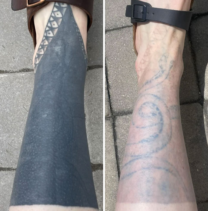 Antes y después de la eliminación de tatuajes en el brazo, mostrando gran cambio visible en la piel con fotos comparativas.