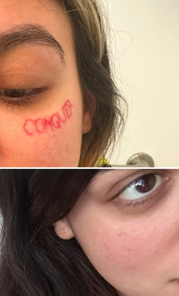 Primer plano de mujer antes y después de la eliminación de tatuaje en la mejilla, mostrando resultados visibles de cambio de vida.