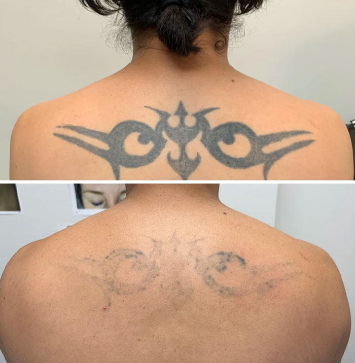 Persona mostrando antes y después de la eliminación de tatuaje tribal en la espalda, cambio visible y progreso en la piel.