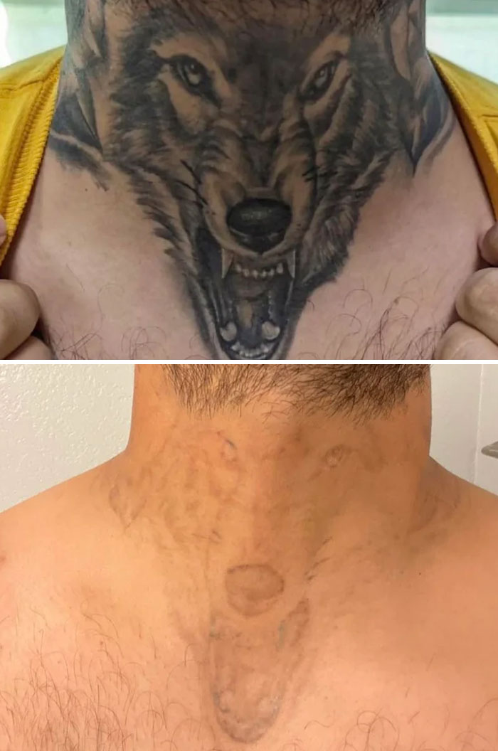 Tatuaje de lobo en cuello antes y después de la eliminación con láser, mostrando resultados de cambio de vida.