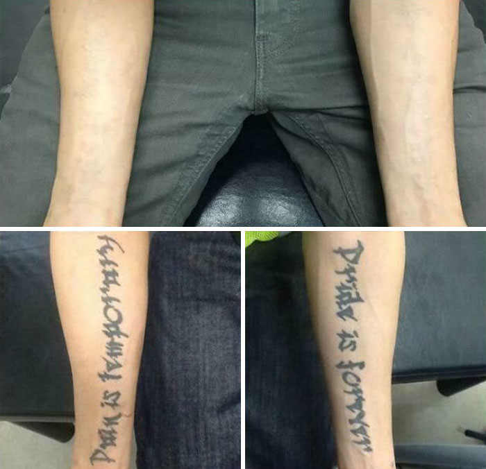 Brazo antes y después de la eliminación del tatuaje, mostrando resultados visibles en proceso de cambio de vida.