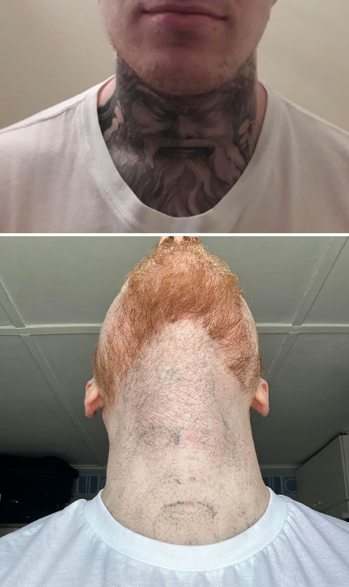 Tatuaje grande en el cuello antes y después de la eliminación, mostrando el cambio de la piel tras el tratamiento.